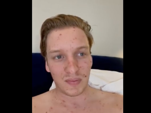 George Ezra cancels gigs after catching chickenpox