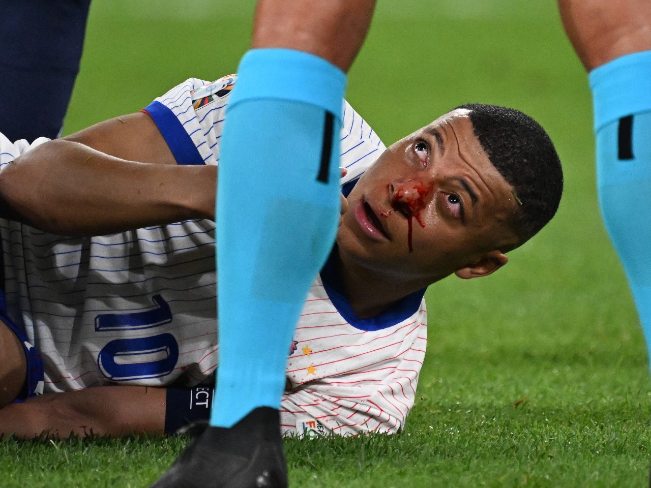 Bloodied Kylian Mbappe taken off with nasty facial injury in France win