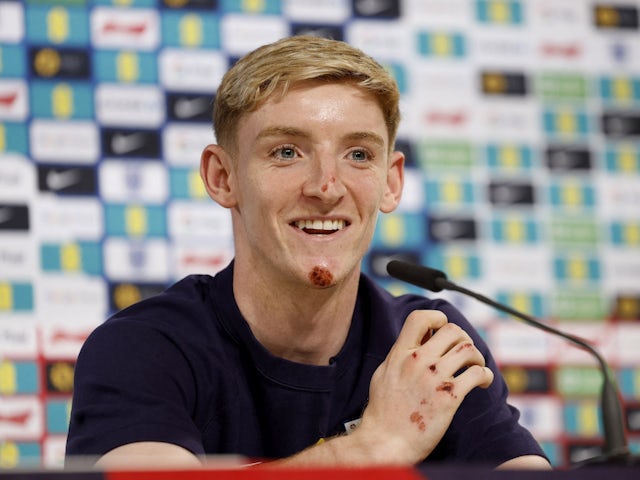 England's Anthony Gordon at an England press conference, sporting the wounds after falling off his bike on June 28, 2024